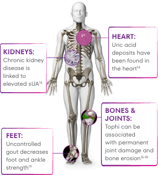 Graphic showing how gout can affect the kidneys, feet, heart, bones, and joints