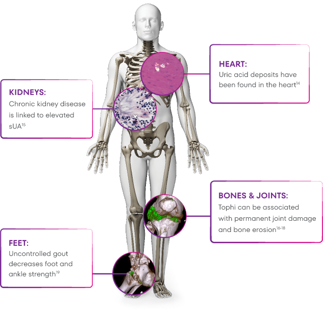 Graphic showing how gout can affect the kidneys, feet, heart, bones, and joints