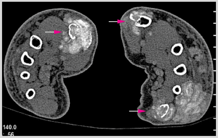CT scan of the hands showing bone erosion