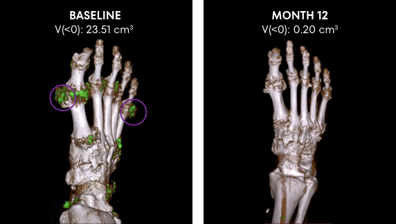 Series of DECT scans showing tophi in foot responding to KRYSTEXXA with methotrexate from baseline to 52 Weeks