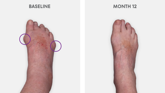 Photo showing KRYSTEXXA with methotrexate tophus response from baseline to 52 Weeks