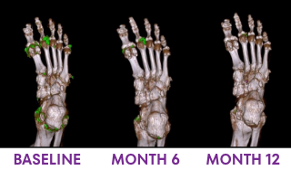 A series of DECT scans showing urate dissolution from baseline to Month 12