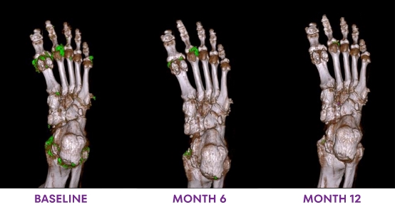 A series of DECT scans showing urate dissolution from baseline to Month 12