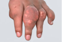 A picture of tophi in fingers of KRYSTEXXA patient, Bet, in April 2019 before treatment