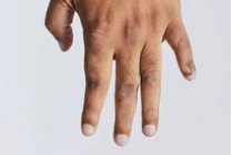 A picture of KRYSTEXXA patient, Bet's, fingers in September 2021, with visible improvement