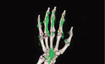 DECT scan of gout patient showing urate deposition in hands
