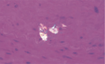 Image of gout patient showing tophi in heart