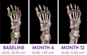 Series of DECT scans showing tophi in foot responding to KRYSTEXXA with methotrexate from baseline to 52 Weeks