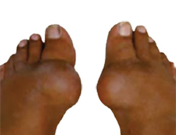 Baseline image of gouty tophi in big toe