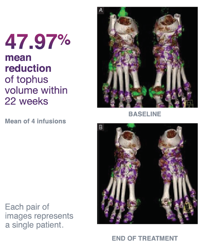 47.97% mean reduction of tophus volume within 22 weeks