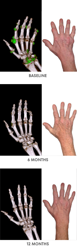 A series of Dual Energy Computed Tomography (DECT) scans before and after KRYSTEXXA with methotrexate treatment, from baseline to 6 months to 12 months, showing reduced uric acid deposits in a hand