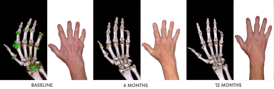 A series of Dual Energy Computed Tomography (DECT) scans before and after KRYSTEXXA with methotrexate treatment, from baseline to 6 months to 12 months, showing reduced uric acid deposits in a hand