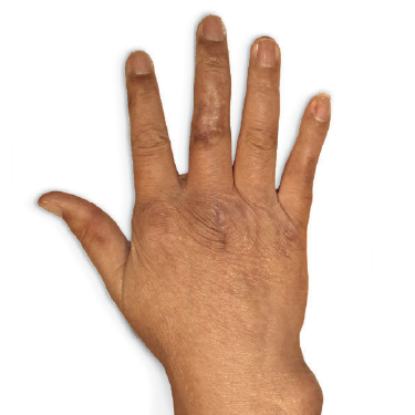 Visible tophi in hands before and after treatment with KRYSTEXXA