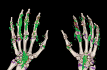 Dual energy CT scan of gout