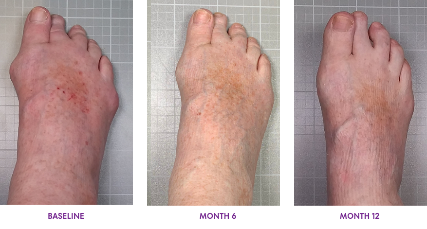 Photo showing KRYSTEXXA with methotrexate tophus response from baseline to Month 12