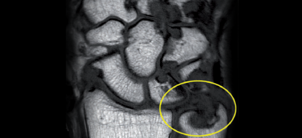 Xray of gout bone erosion, coronal view