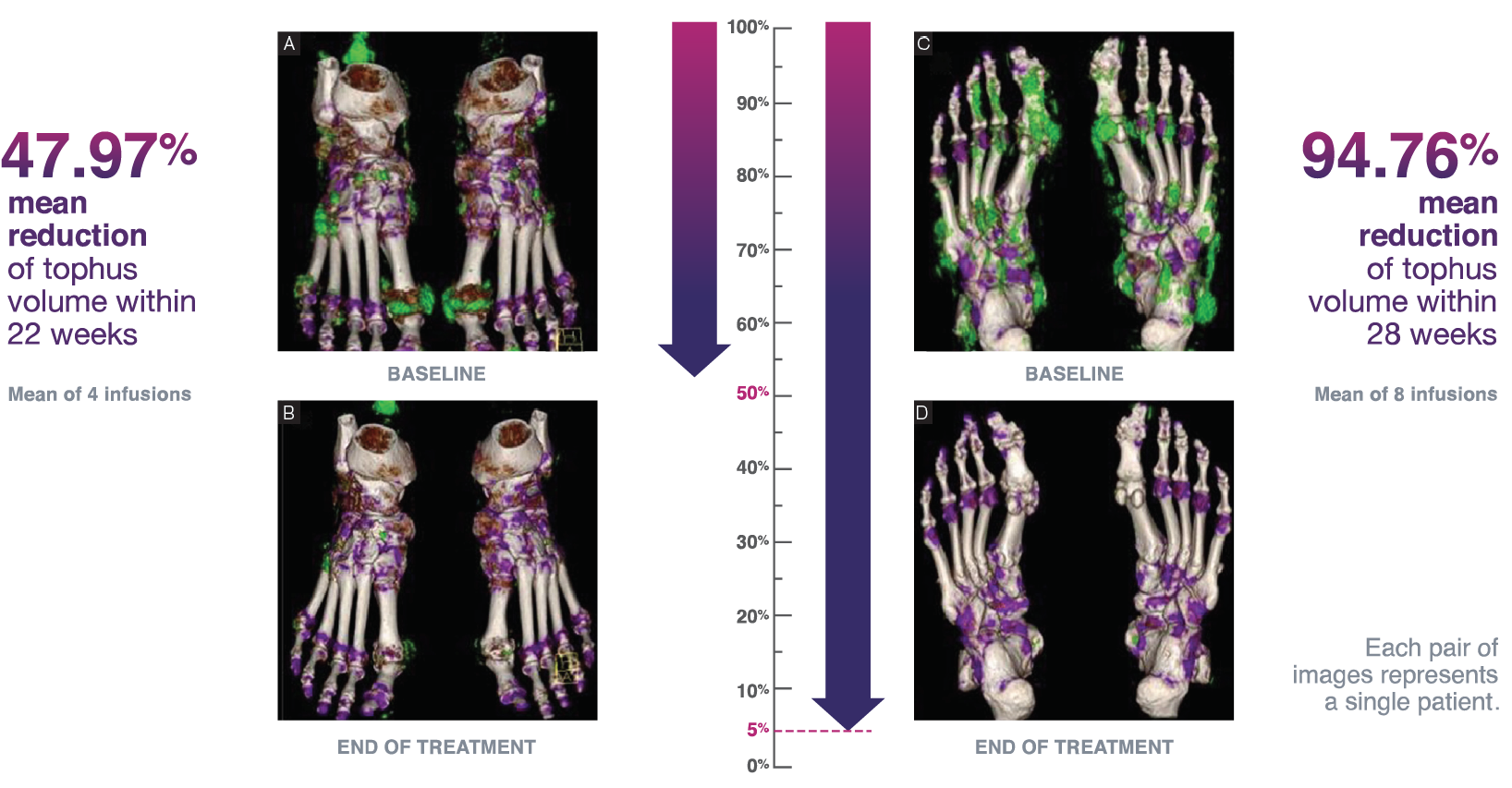 Side by side comparison of DECT scans showing tophi volume for KRYSTEXXA (pegloticase) patients with incomplete sUA response (n=5) and complete sUA response (n=5)