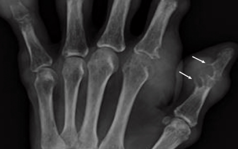 Radiograph of gout patient's hand showing bone erosion