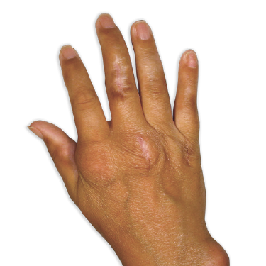 Picture of tophi on fingers and hand after three months of treatment with KRYSTEXXA (pegloticase)