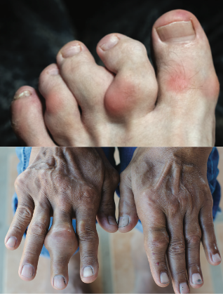 Side by side images of tophi in toes and hands