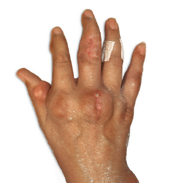 Comparison of hand before and after treatment with KRYSTEXXA