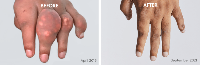 Picture of tophi in hand before and after KRYSTEXXA treatment, from April 2019 to September 2021