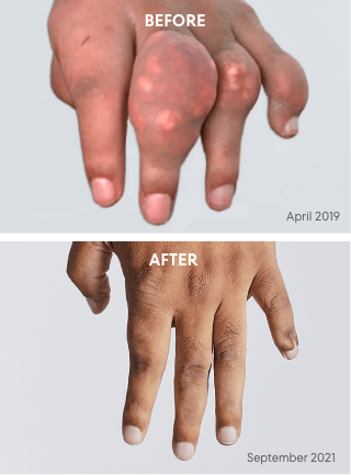 Picture of tophi in hand before and after KRYSTEXXA treatment, from April 2019 to September 2021