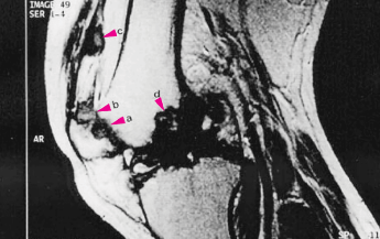 Gout x-ray showing tophi and limited joint motion in a gout patient's knee
