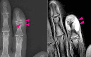 Side by side comparison of a radiograph and MRI, displaying tophi-associated joint damage in fingers