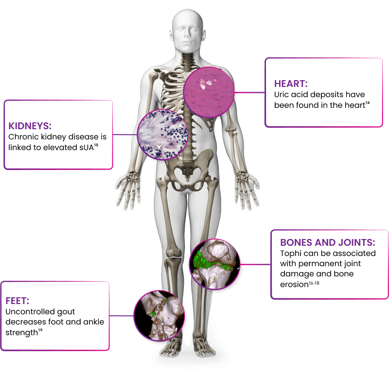 Systemic Gout Symptoms | KRYSTEXXA® (pegloticase) for HCPs