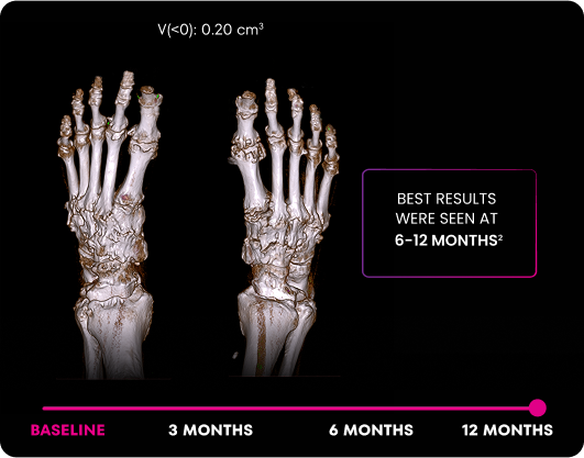 DECT image of uric acid deposits from gout in feet of KRYSTEXXA with methotrexate patient at 12 months