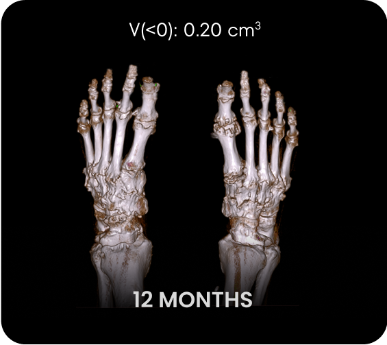 DECT image of uric acid deposits from gout in feet of KRYSTEXXA with methotrexate patient at 12 months