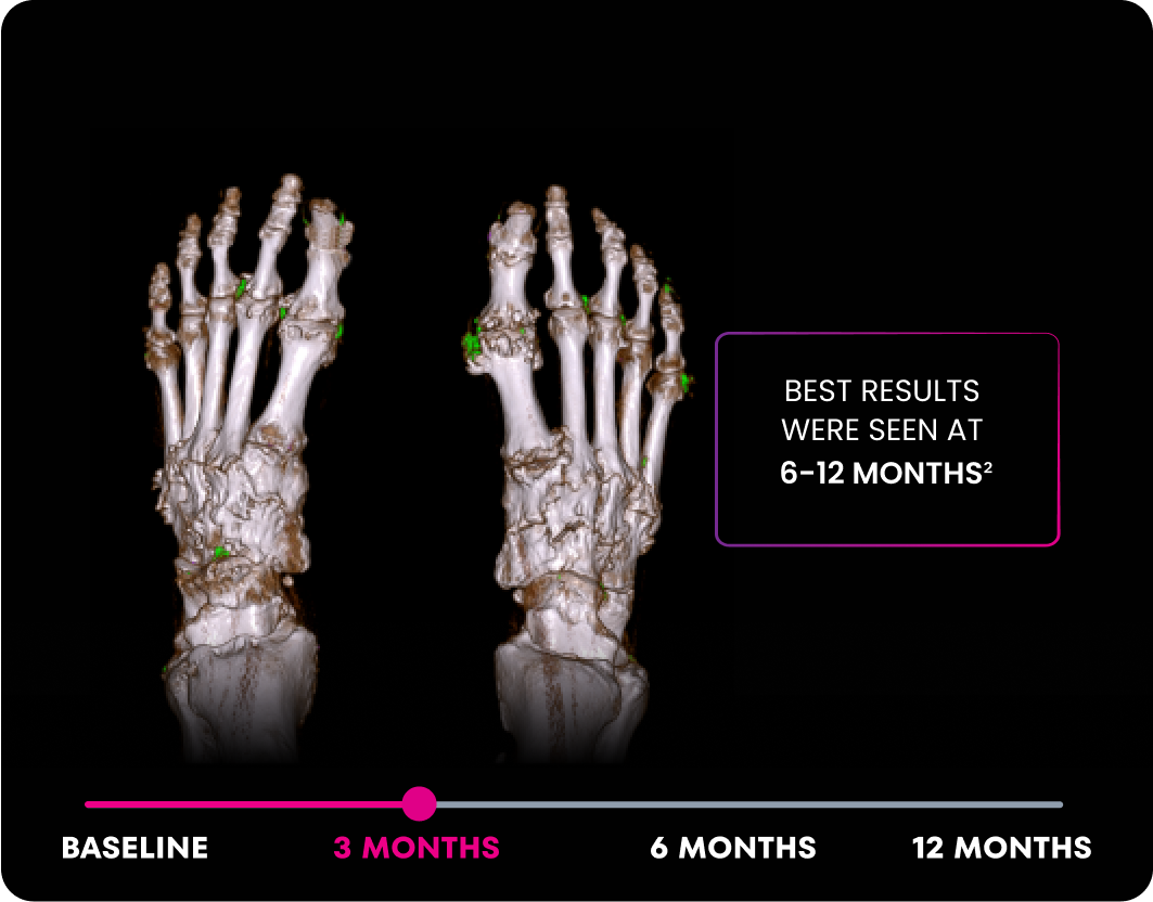 DECT image of uric acid deposits from gout in feet of KRYSTEXXA with methotrexate patient at 3 months