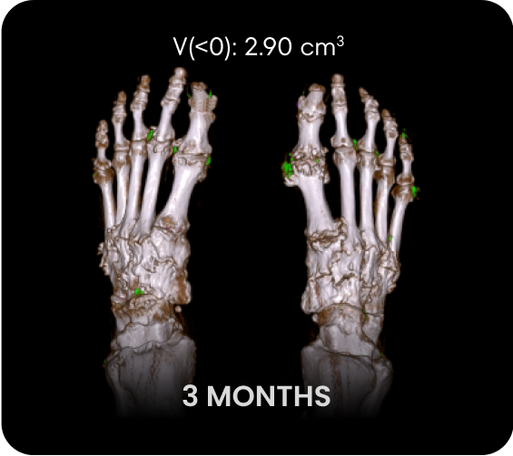 DECT image of uric acid deposits from gout in feet of KRYSTEXXA with methotrexate patient at 3 months