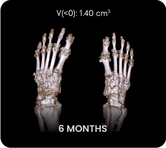 DECT image of uric acid deposits from gout in feet of KRYSTEXXA with methotrexate patient at 6 months