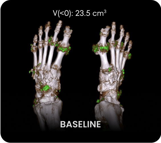 DECT image of uric acid deposits from gout in feet of KRYSTEXXA with methotrexate patient at baseline