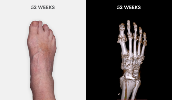 Photo showing no visible tophi in foot as well as no uric acid deposits in DECT scan after 52 weeks of treatment