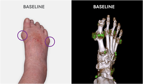 Baseline photo showing visible tophi in foot as well as uric acid deposits in DECT scan
