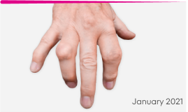 Hand with tophi, before Krystexxa, dated January 2021