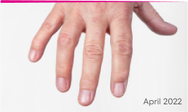 Hand with reduced tophi, after Krystexxa, dated April 2022