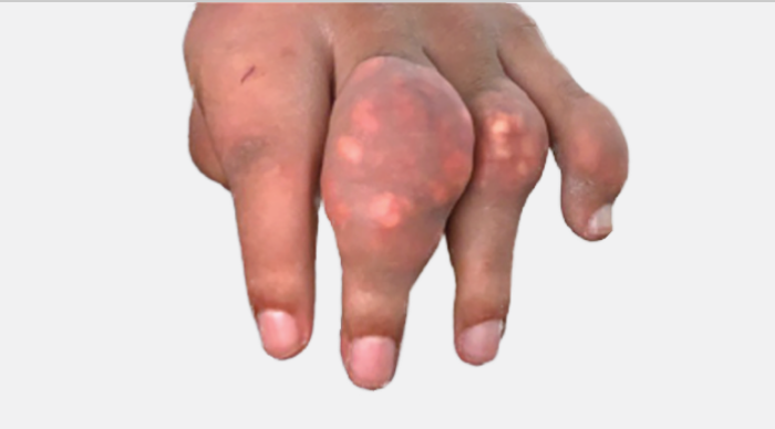 Image of visible tophi in hand before KRYSTEXXA treatment