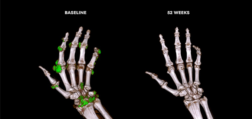 DECT scan showing uric acid buildup in hands at baseline and 52 weeks into treatment