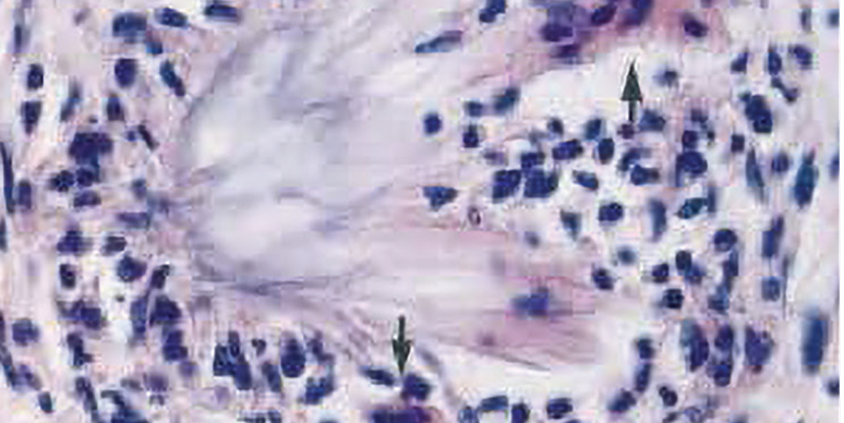 High power view of a tophus