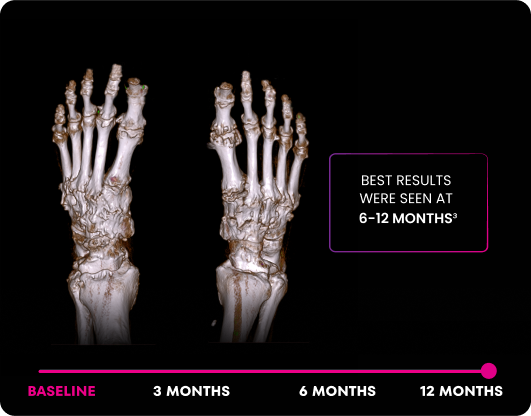 DECT image of uric acid deposits from gout in feet of KRYSTEXXA with methotrexate patient at 12 months