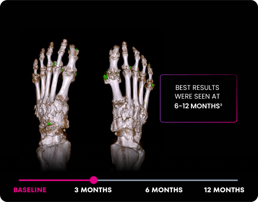 DECT image of uric acid deposits from gout in feet of KRYSTEXXA with methotrexate patient at 3 months