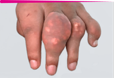 Image of visible tophi in hand before KRYSTEXXA treatment