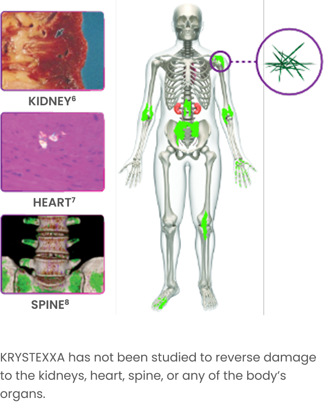 Graphic showing how gout can affect the kidneys, heart, and spine