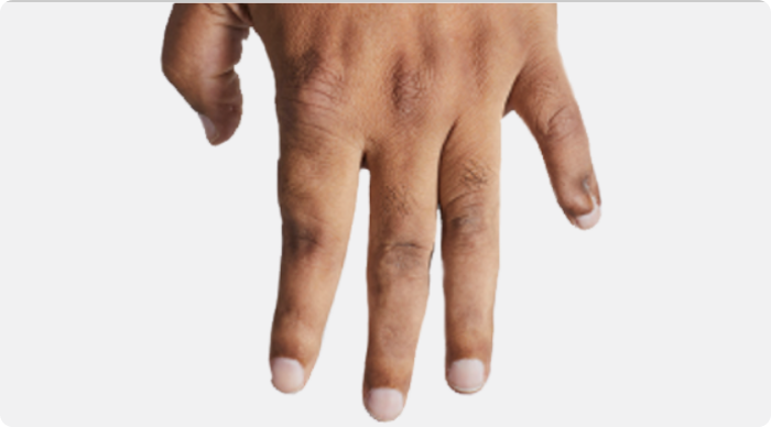  Image of no visible tophi in hand after KRYSTEXXA with methotrexate treatment 