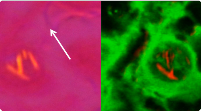 Image of negatively birefringent crystals in gout microscopy