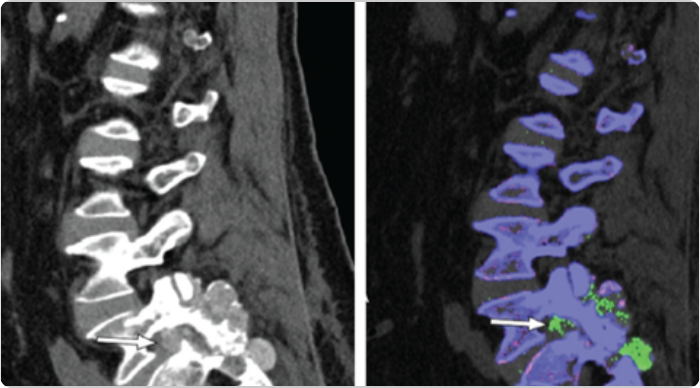DECT scans of lumbar spine showing tophaceous deposits